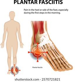 Illustration of foot pain and affected areas