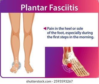 Illustration of foot pain and plantar fasciitis symptoms