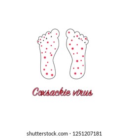 Illustration of foot with red pimples. Coxsackie virus.