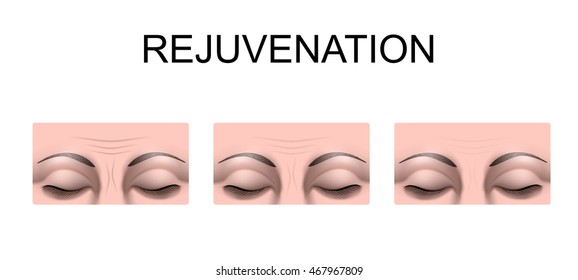 illustration of forehead wrinkles. rejuvenation. plastic surgery
