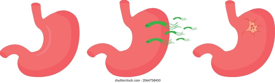 Illustration of the formation of stomach ulcers due to Helicobacter pylori. Gastroenterological disease. Gastritis and ulcers of the stomach and duodenum.