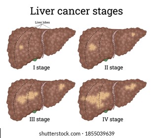 Illustration Nonalcoholic Fatty Liver Disease Comparison Stock Vector ...