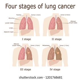 Illustration of the four stages of oncological disease - lung cancer