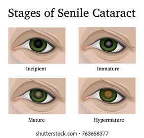 Illustration of the four stages of Senile cataracts, such as incipient, immature, mature and hypermature.