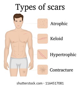 Illustration of four types of scars on the body of a man