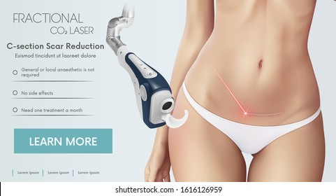 Illustration With Fractional CO2 Laser For C-section Scar Reduction And Beautiful Woman's Body With Scar After Cesarean Section. Vector Illustration 