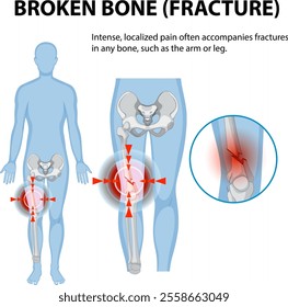 Illustration of fracture pain in human bones