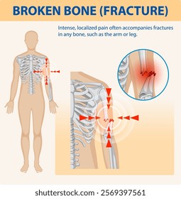 Illustration of fracture pain in human bones