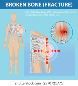 Illustration of fracture pain in human bones