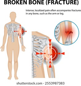 Illustration of fracture pain in human skeleton