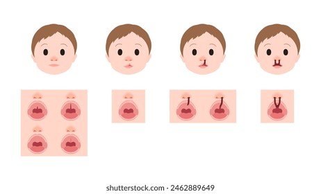 Illustration of the front appearance of cleft lip and palate and the appearance when opening the mouth