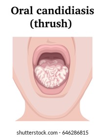 Illustration of a fungal infection - Oral candidiasis