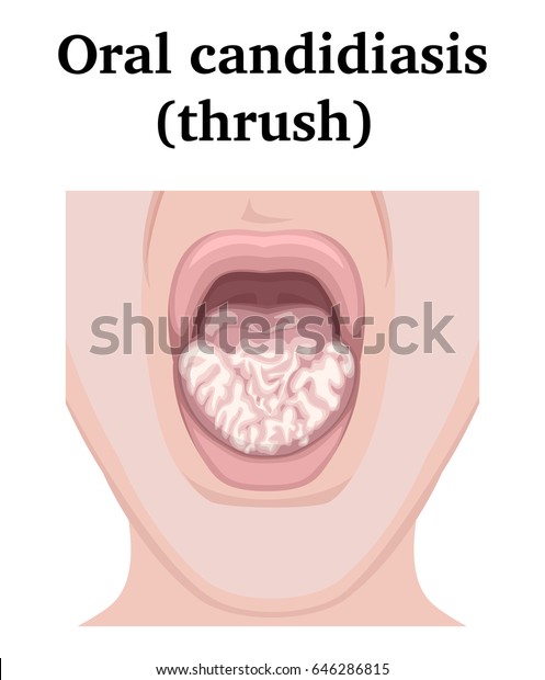Illustration Fungal Infection Oral Candidiasis Stock Vector (Royalty ...