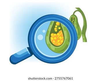 Illustration of gallbladder with gallstones under magnification showing bile buildup digestive disorder and abdominal health concept.
