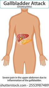 Illustration of gallbladder inflammation and abdominal pain