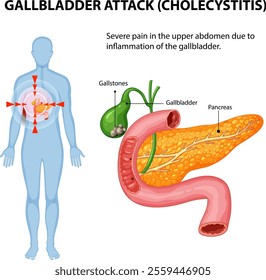 Illustration of gallbladder inflammation and abdominal pain