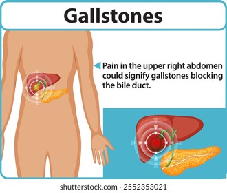 Ilustración de cálculos biliares que afectan el conducto biliar