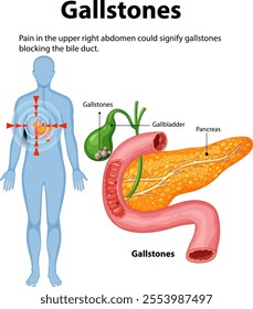 Illustration of gallstones affecting the bile duct