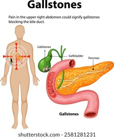 Illustration of gallstones affecting the gallbladder and pancreas
