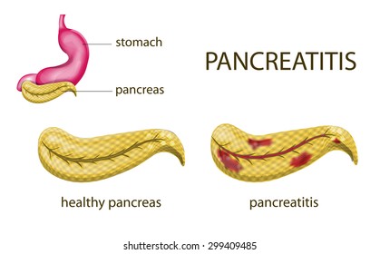 illustration of the gaster, pancreas and pancreatitis