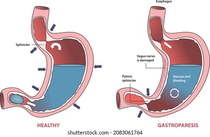 500 Gastroparesis Images, Stock Photos & Vectors | Shutterstock