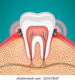 illustration of gingivitis. A detailed cross section of the tooth. The process of inflammation. Vector illustration.
