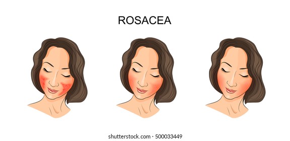 illustration of girl's face,  damaged rosacea. dermatology
