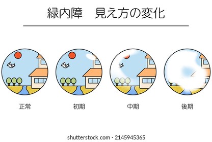 Illustration of glaucoma, changes in visual field as glaucoma progresses, medical illustrations - Translation: changes in glaucoma vision, normal, early, middle, late