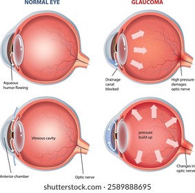 illustration of glaucoma eye diagram