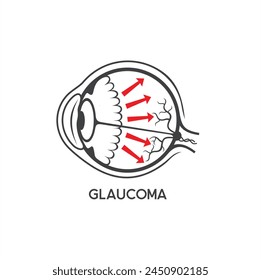 illustration of glaucoma, glaucoma eye sufferers.