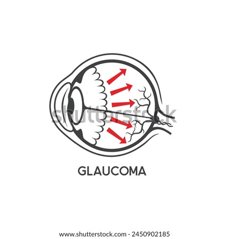 illustration of glaucoma, glaucoma eye sufferers.
