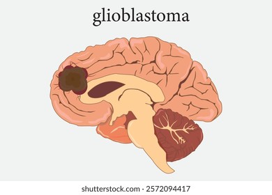 illustration of glioblastoma, medical education. eps 10