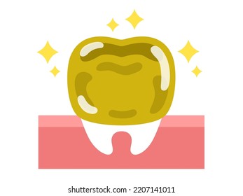 Illustration of a gold tooth.