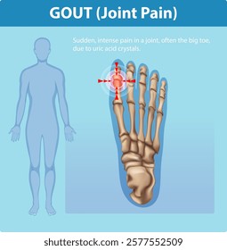 Illustration of gout affecting the big toe joint