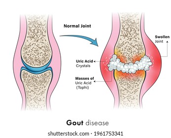 Illustration Of Gout Disease In Human, Auto Immune Disorder In Humans. Joint Pain. 