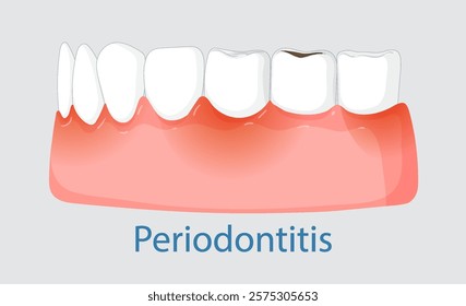 Illustration of gum disease affecting dental health