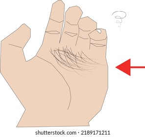 Illustration of hair loss on hand