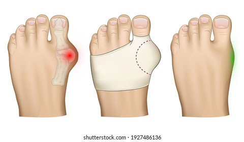 Illustration of the Hallux valgus problem. Treatment with a bandage of the protruding bone on the leg.Anatomical image of the foot