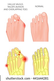 Illustration of the hallux valgus, Tailor's bunion and overlapping or displaced toes. Used: gradient, transparency.