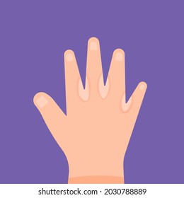 illustration of a hand affected by skin disease or ringworm between the fingers. fungus on the skin. flat cartoon style. vector design elements