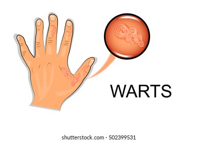 illustration of a hand affected by the wart