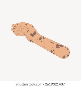 Illustration of a hand and arm with vitiligo spots on light skin. Simple, minimalistic design showing vitiligo. Focus on skin condition, vitiligo representation. Arm illustration, isolated vector.