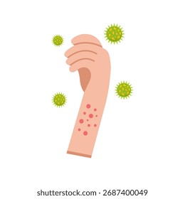 Illustration Of Hand With Measles
