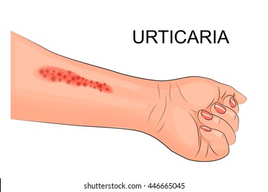 illustration of a hand of the patient suffering from hives
