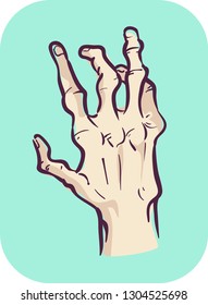 Illustration of a Hand Showing Joint Deformity