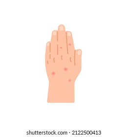 illustration of a hand suffering from skin disease, hives, chickenpox. pain, itching, disease, health problems. flat cartoon. element design