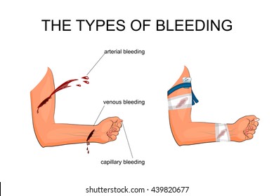 illustration of hand with the types of bleeding. The imposition of hemostatic tourniquet and a pressure bandage