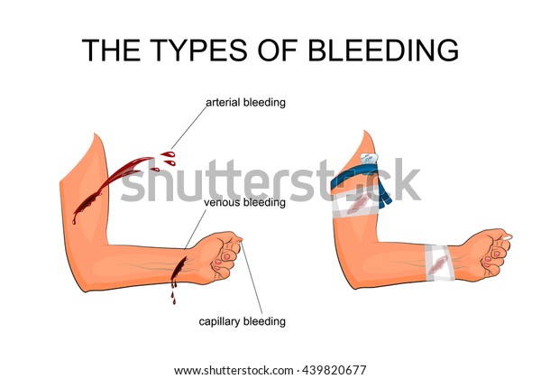 illustration of hand\
with the types of bleeding. The imposition of hemostatic tourniquet\
and a pressure\
bandage\
