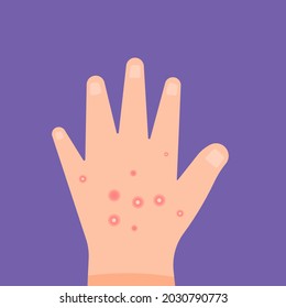 illustration of hands affected by skin diseases, bumps, skin pimples, boils. itchy red itchy skin. fungus on the skin. flat cartoon style. vector design elements