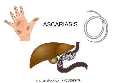 illustration hands dirty, roundworm obstruction in the liver